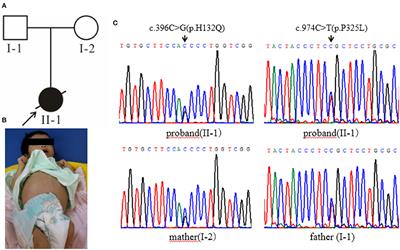 High-Throughput Sequencing Reveals the Loss-of-Function Mutations in GALT Cause Recessive Classical Galactosemia